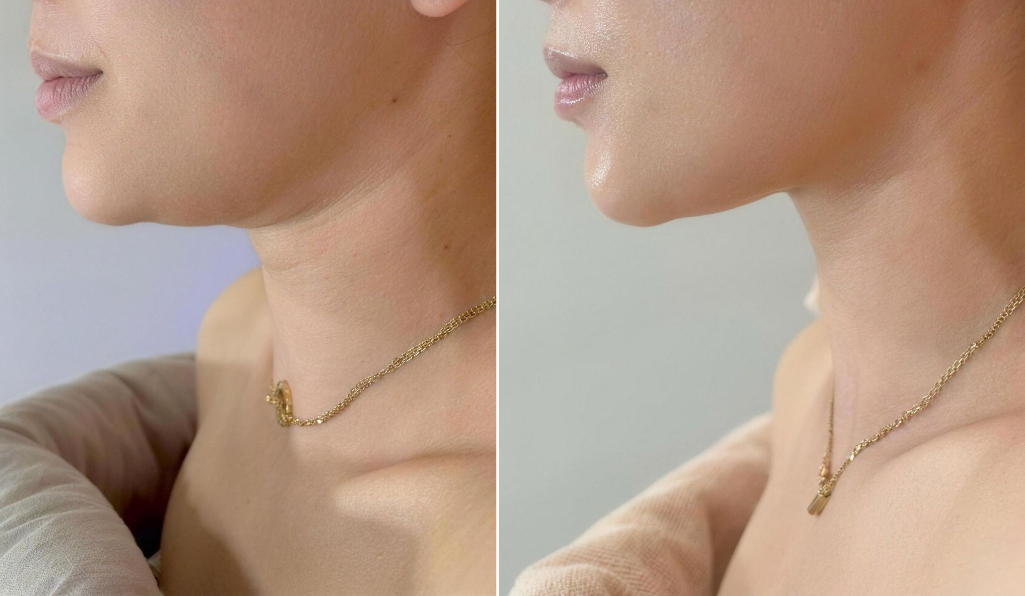 턱선·목 라인 리프팅 전후 비교 — 관리 후 턱선이 또렷해지고 목 라인이 길고 매끈하게 정리된 옆모습